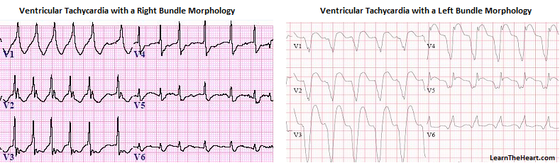 left and right bundle branch bloack arrhythmia